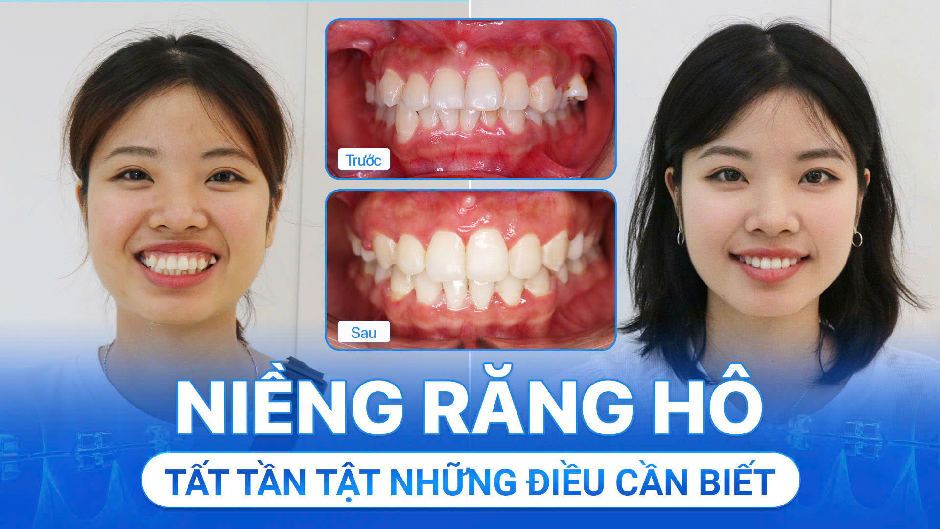 Niềng hô mất bao lâu chi phí thế nào, Tất cả các lưu ý cần biết để có một ca niềng thành công