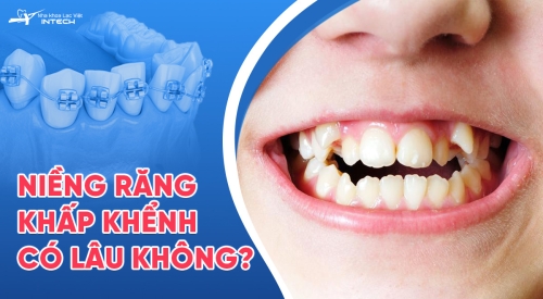 Niềng răng khấp khểnh mất bao lâu? Chi phí hết bao nhiêu tiền?