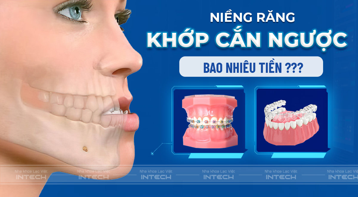 Thông tin về niềng răng khớp cắn ngược và chi phí tại Việt Nam