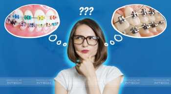  Mắc cài kim loại thường là gì? Có nên lựa chọn niềng răng không