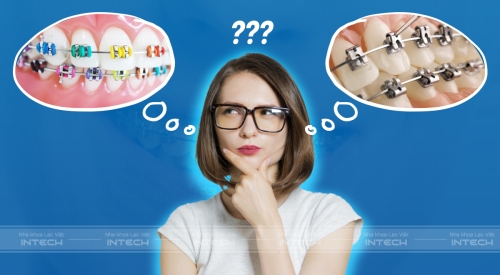  Mắc cài kim loại thường là gì? Có nên lựa chọn niềng răng không