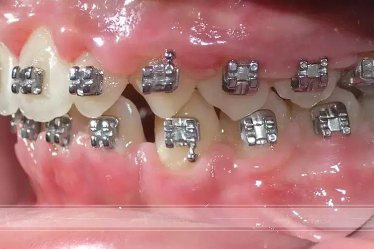 Niềng răng sai kỹ thuật có thể bị viêm lợi