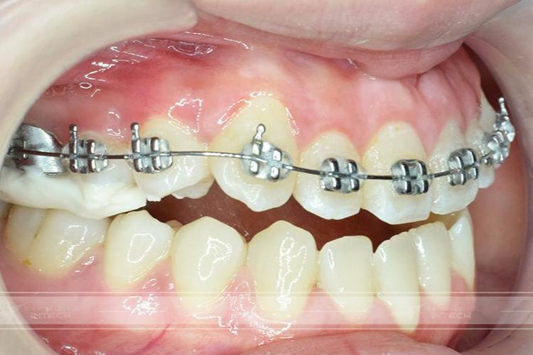 Niềng răng sai kỹ thuật gây tổn thương men răng