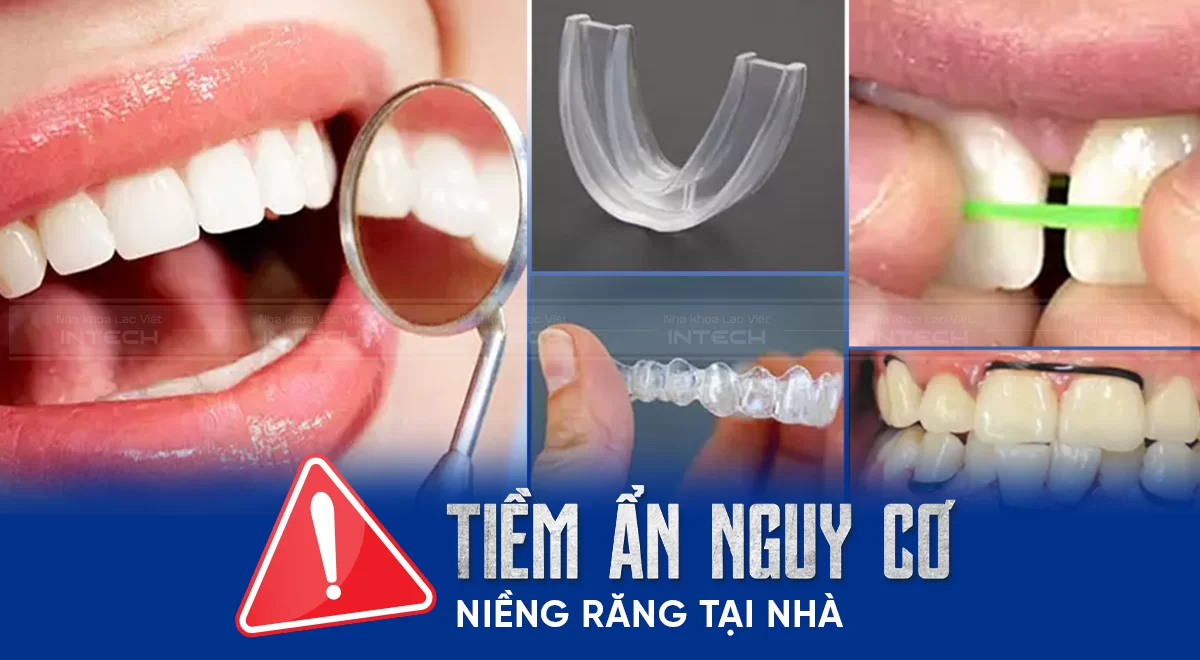 Niềng răng tại nhà - Tiềm ẩn nguy cơ tổn hại sức khỏe