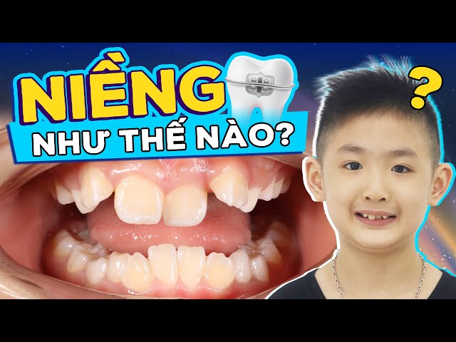 Niềng răng trẻ em: Lợi ích, rủi ro và những điều cha mẹ cần biết