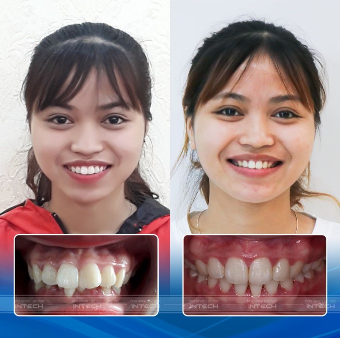 trước và sau niềng răng