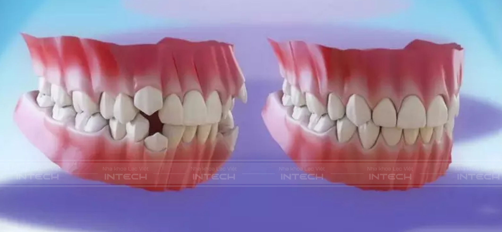 Lợi ích của niềng răng