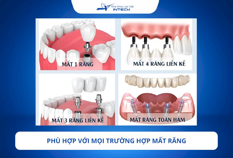 Trụ Implant Nobel Biocare Thụy Điển phù hợp với mọi trường hợp mất răng