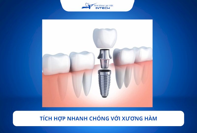 Trụ Implant Nobel Biocare Thụy Điển sử dụng công nghệ xử lý bề mặt TiUnite giúp trụ bám chắc và kích thích tạo xương nhanh