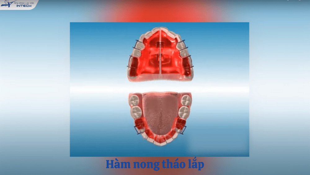 Hàm nong tháo lắp