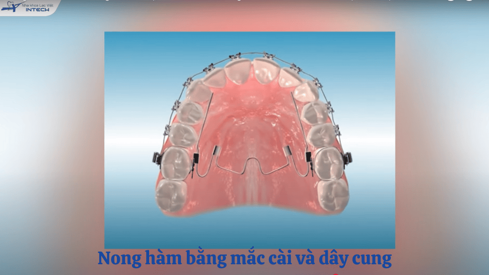 Nong hàm bằng dây cung