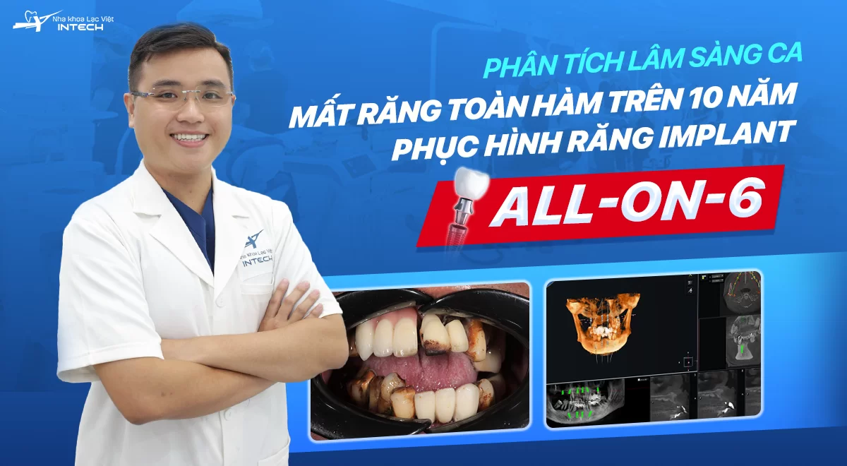 Phân tích lâm sàng ca mất răng 10 năm, làm cầu răng sứ hỏng