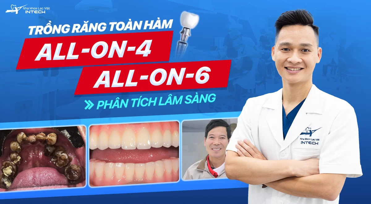 Phân tích lâm sàng ca mất nhiều răng 2 hàm, răng lung lay do hút thuốc lá lâu năm