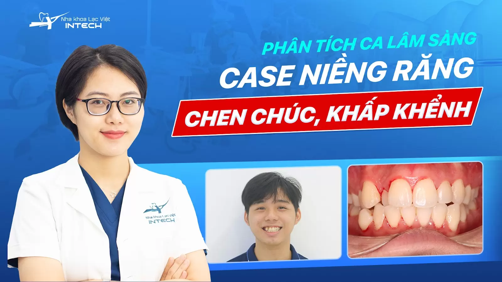 Phân tích lâm sàng trường hợp răng chen chúc, khấp khểnh