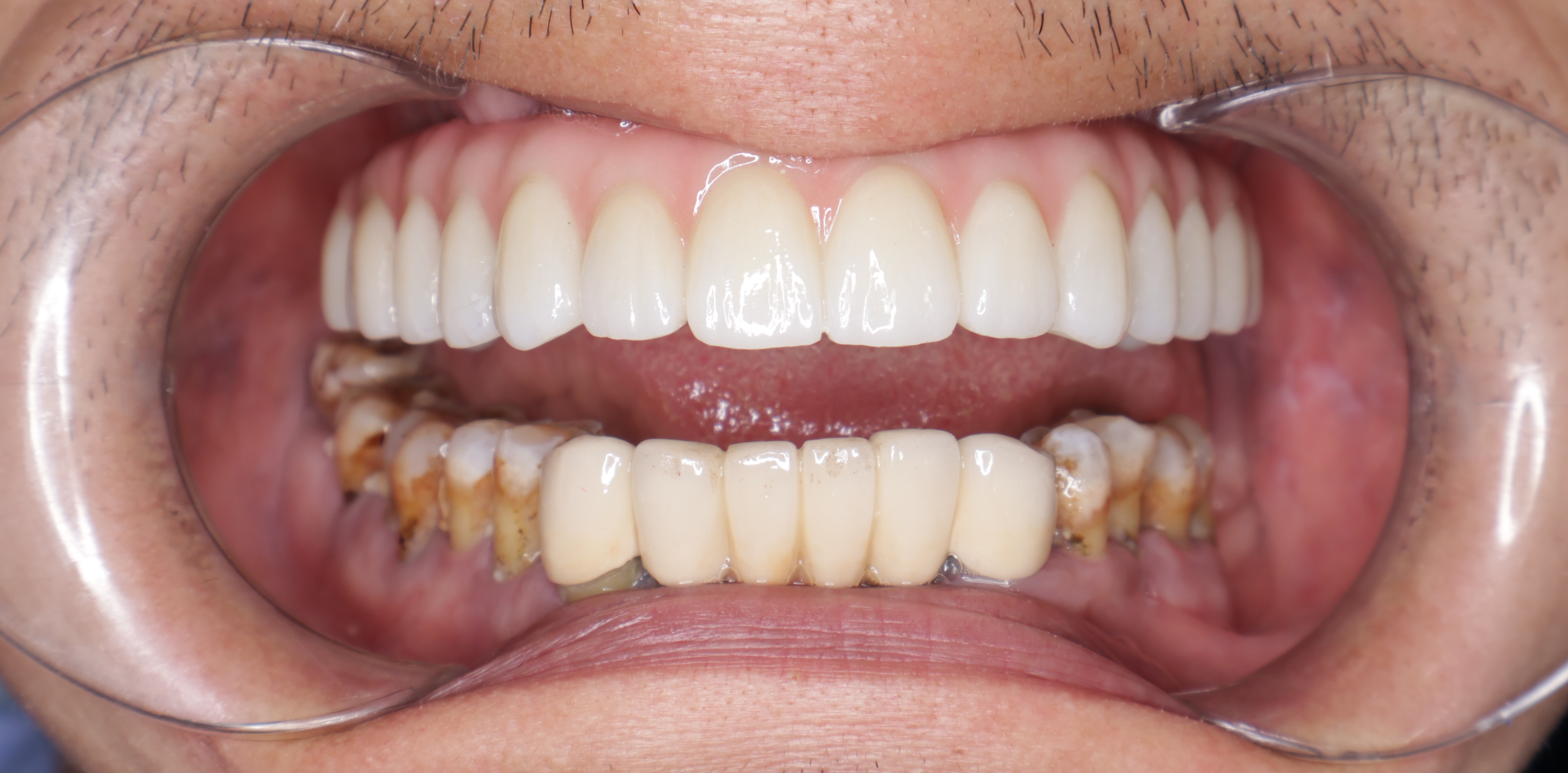 Cận cảnh hàm răng mới sau hoàn tất phục hình tại nha khoa Lạc Việt Intech