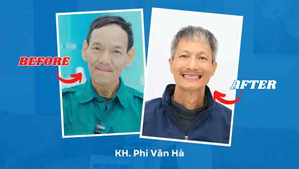 Hành trình "Tìm lại vị Tết" sau 10 năm mất răng của chú Phí Văn Hà nhờ trồng răng implant