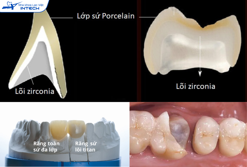 Răng toàn sứ đa lớp khắc phục được hạn chế màu sắc của lõi kim loại nhưng độ bền kém