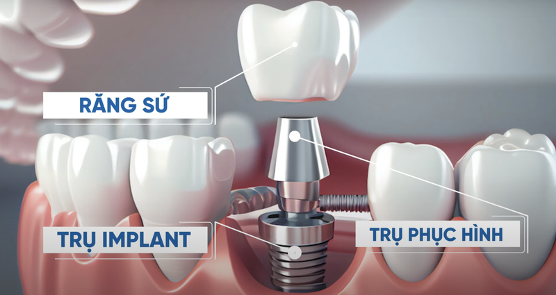 Tìm hiểu về đặc điểm và quy trình phục hình răng sứ trên Implant