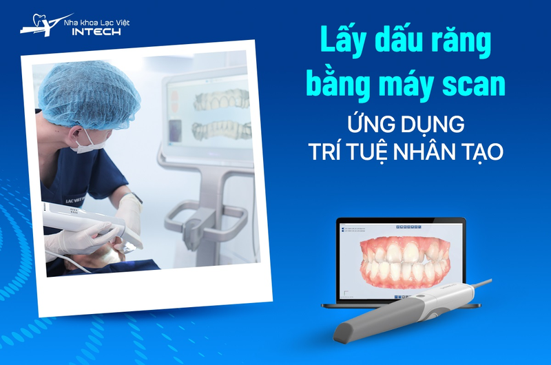 Sau khi trụ Implant tích hợp thành công, bác sĩ sẽ tiến hành lấy dấu hàm để thiết kế mão răng sứ cá nhân hóa