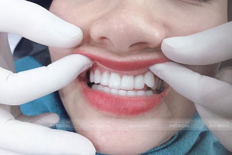 Phương pháp bọc sứ răng khểnh