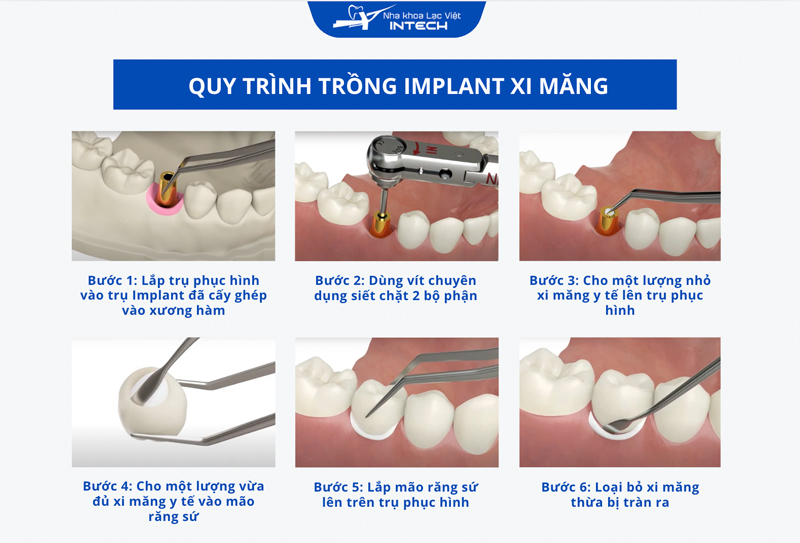 Phương pháp Implant xi măng sẽ dùng xi măng y tế để cố định mão răng sứ và trụ phục hình, dẫn đến khó tháo lắp và thay thế