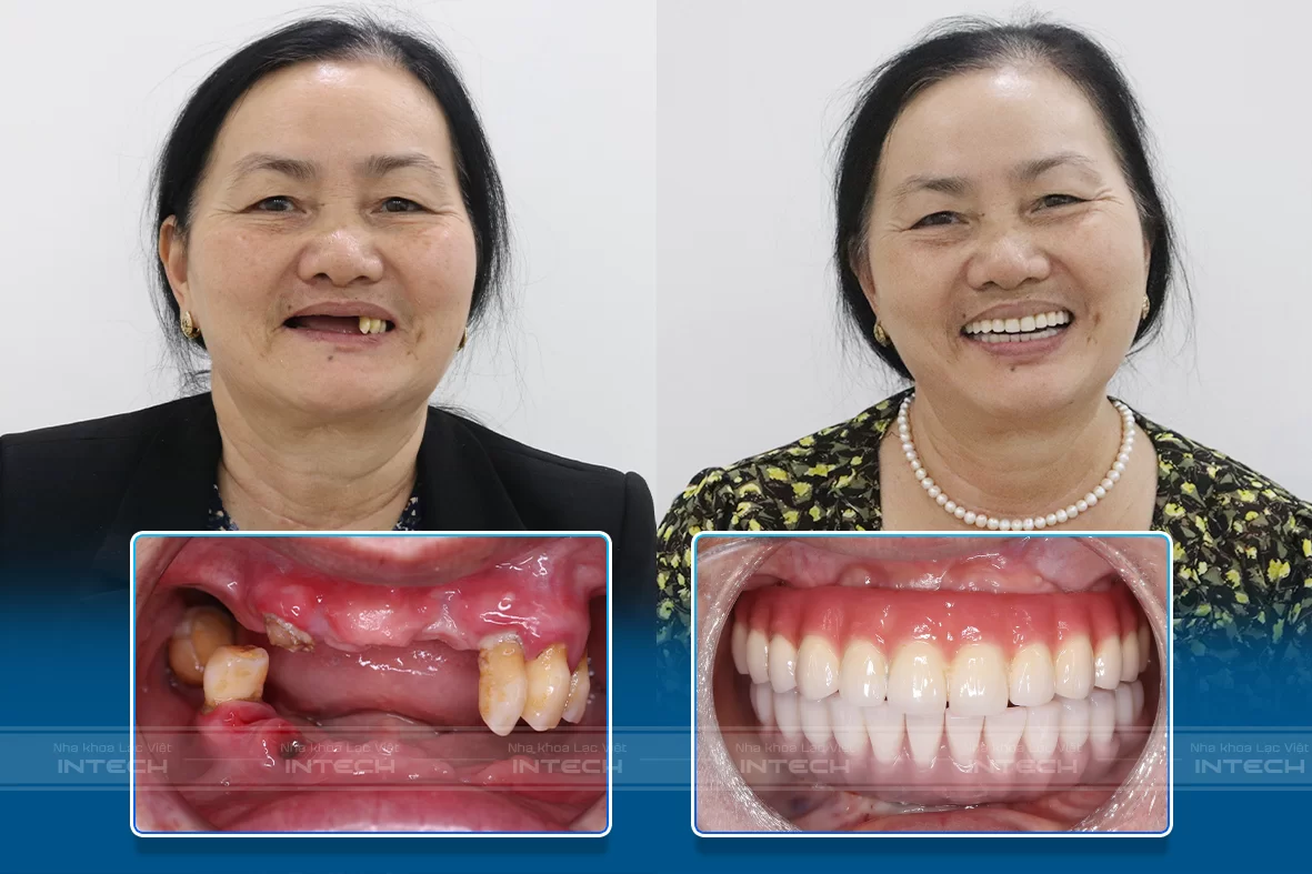 Phương pháp trồng răng Implant đạt thẩm mỹ cao, giúp bệnh nhân lại lại sự tự tin trong giao tiếp hằng ngày