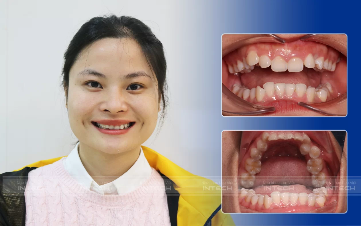Phân tích lâm sàng tình trạng răng chen chúc, khấp khểnh và khớp cắn sâu nặng