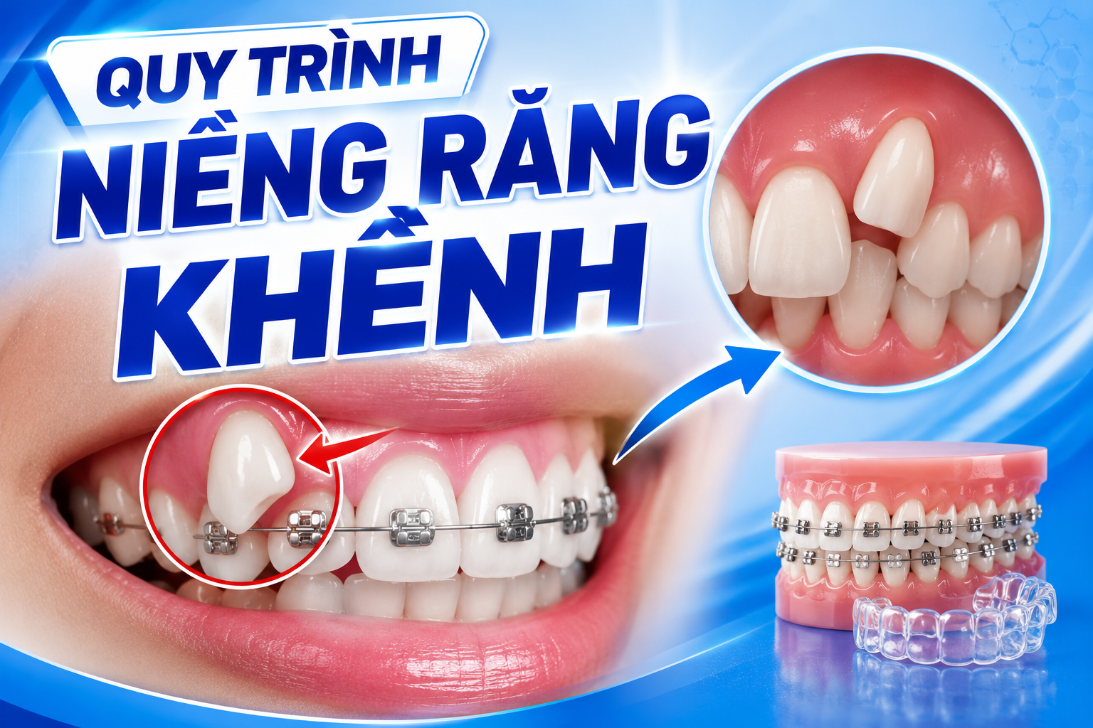Quy trình niềng răng khểnh chi tiết tại Nha khoa Lạc Việt Intech