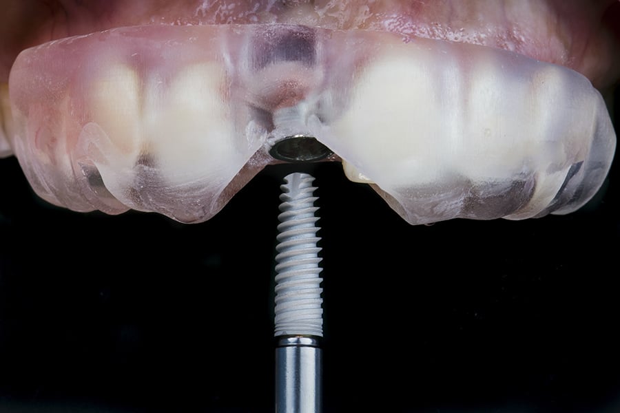 Quy trình trồng răng Implant diễn ra nhanh chóng, chỉ từ 15 - 20 phút/trụ Implant