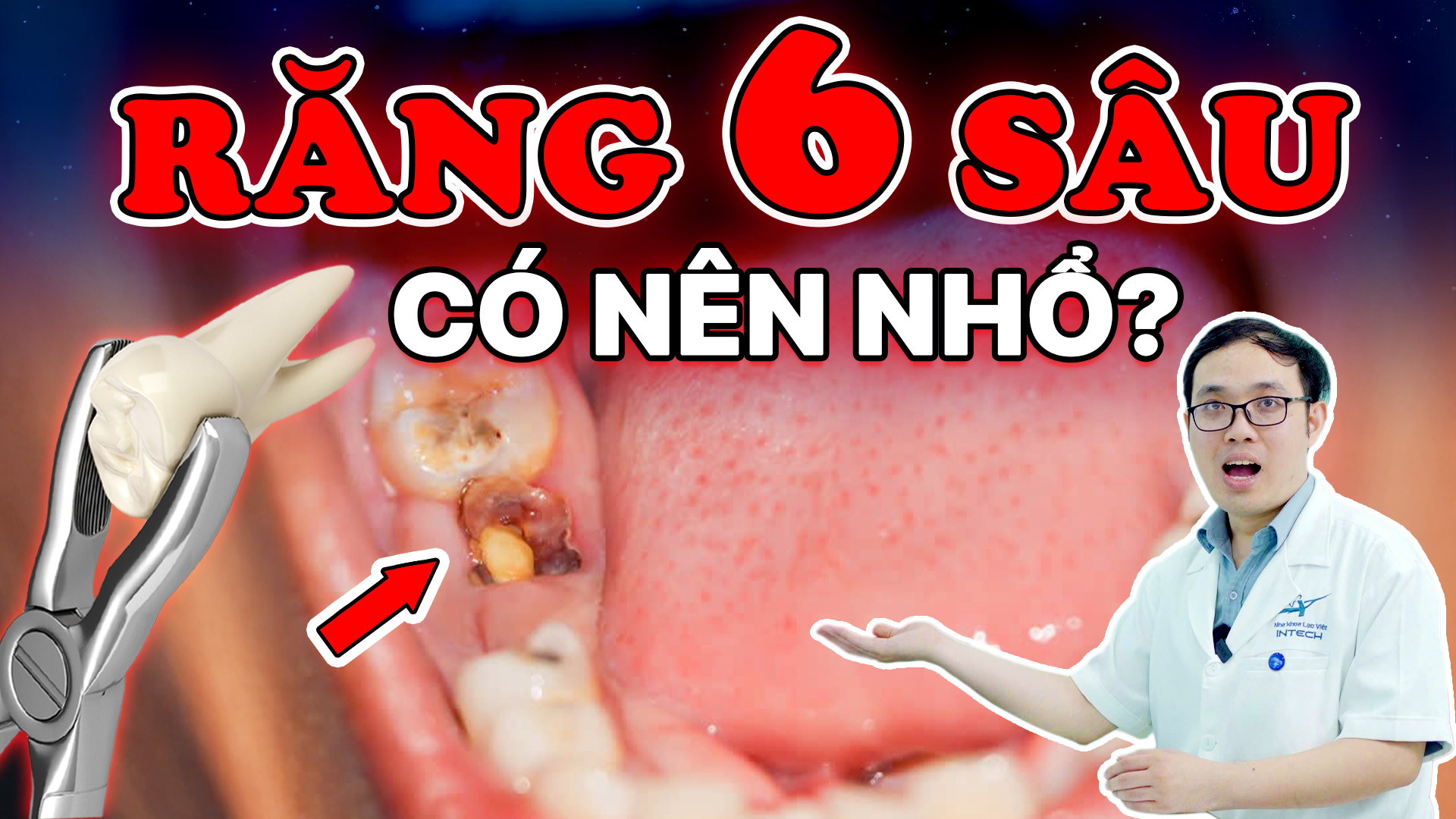 Răng số 6 bị sâu phải làm sao? 6 trường hợp bắt buộc phải nhổ bỏ