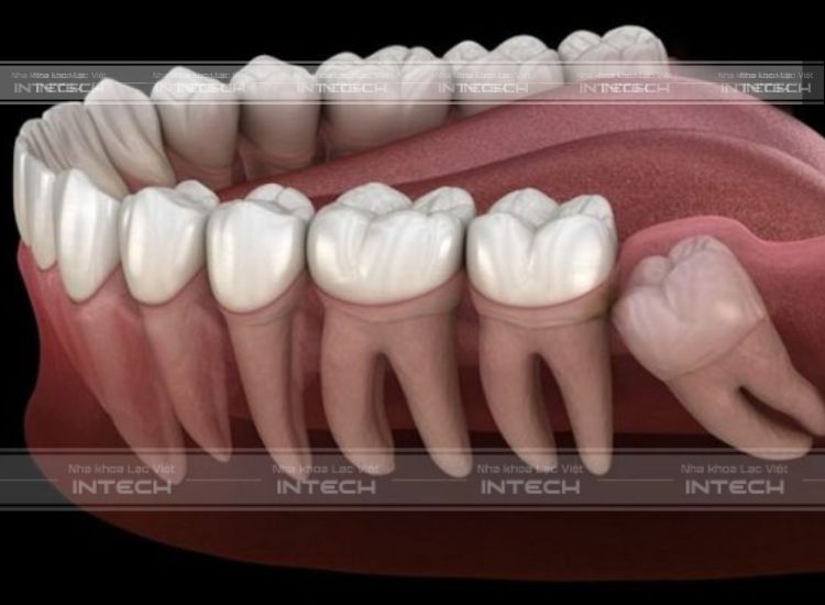Răng 8 có thể khiến xô lệch cả hàm răng