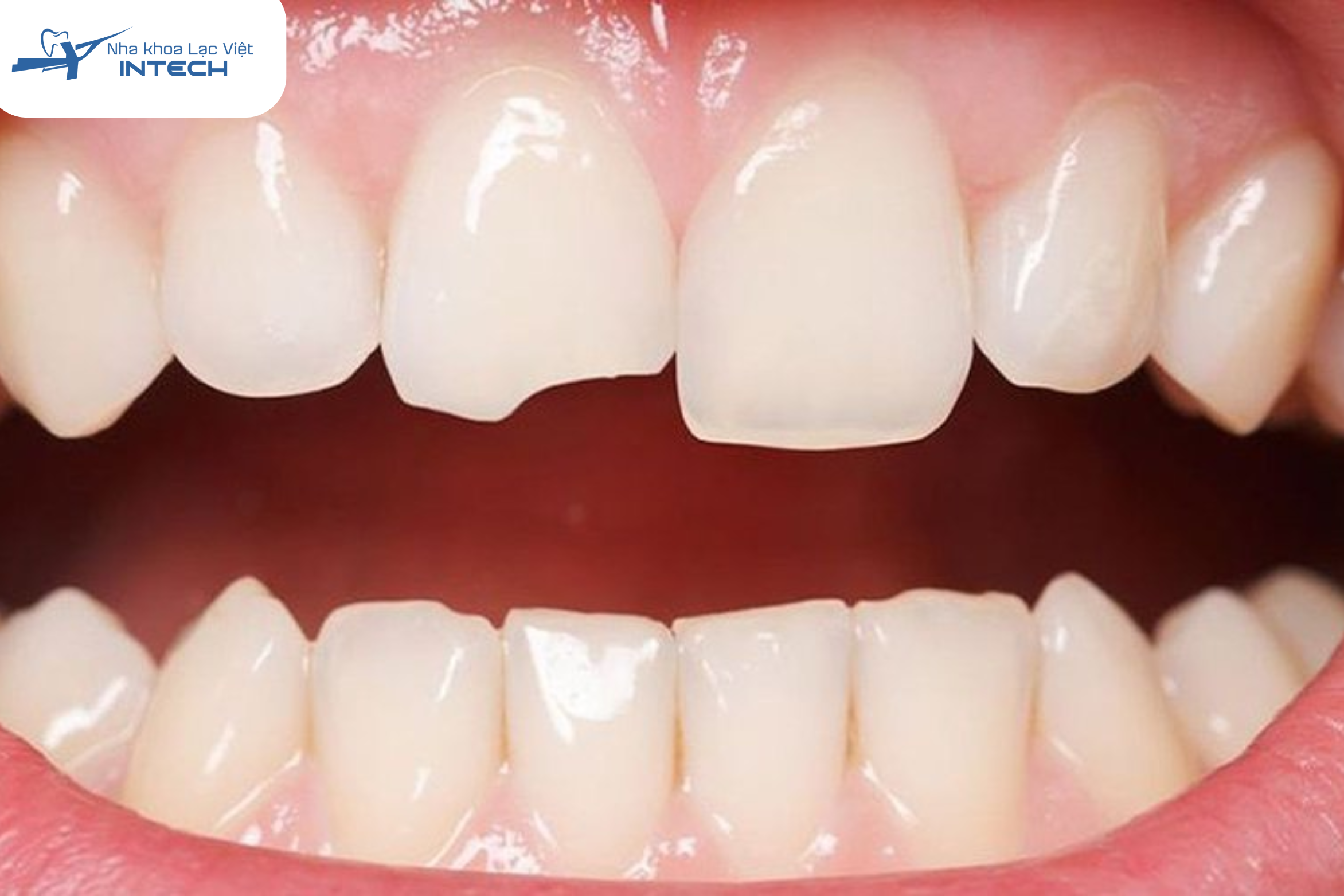 Răng chỉ bị sứt mẻ nhỏ ở rìa cắn hoặc bề mặt thì không nên bọc sứ 