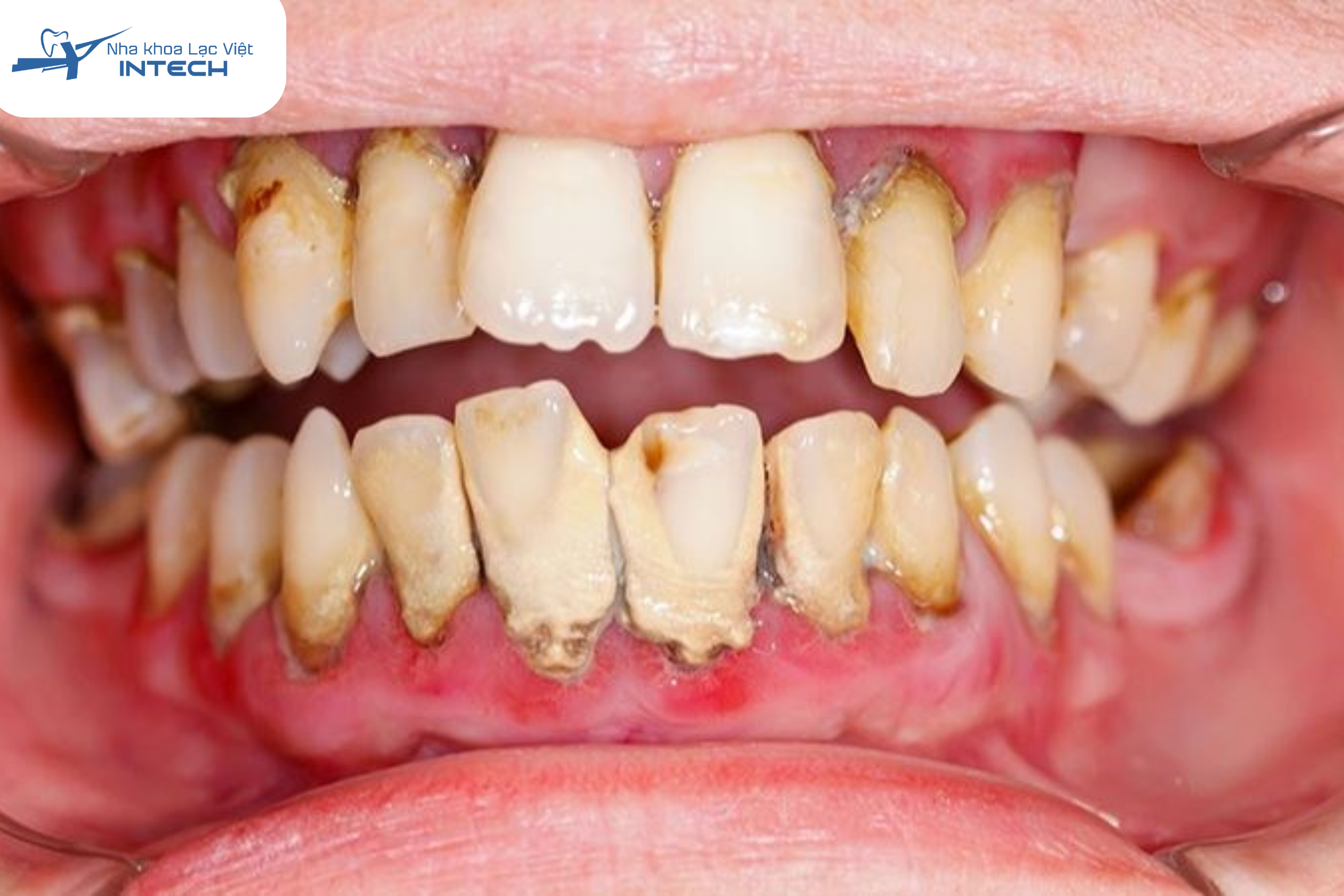 Răng bị viêm nha chu nặng không nên bọc sứ để che lấp mầm bệnh