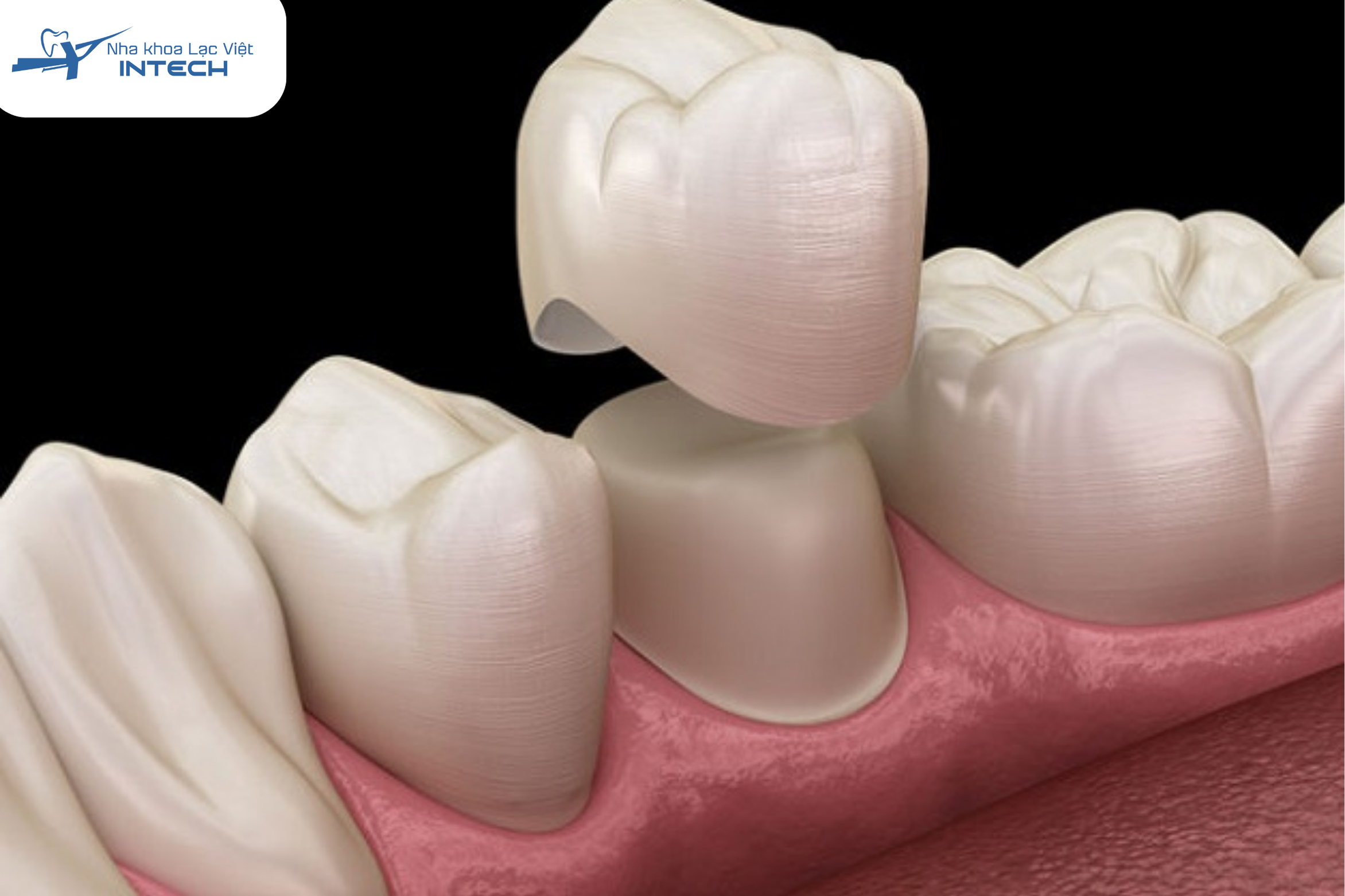 Bọc răng sứ sử dụng một mão răng (lớp bọc) được làm bằng chất liệu sứ để chụp lên toàn bộ phần răng thật đã mài