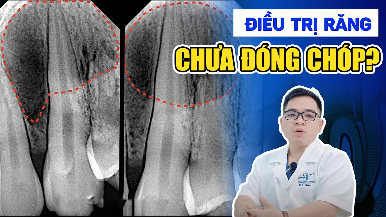 Răng Chưa Đóng Chóp Là Gì? Trẻ Dễ Rụng Răng Vĩnh Viễn Sớm, Phụ Huynh Chớ Xem Thường!