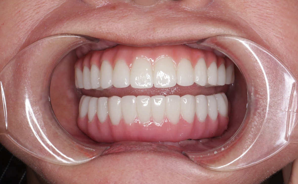 Tính thẩm mỹ cao là ưu điểm lớn khi nhắc đến hàm toàn hàm Thimble.