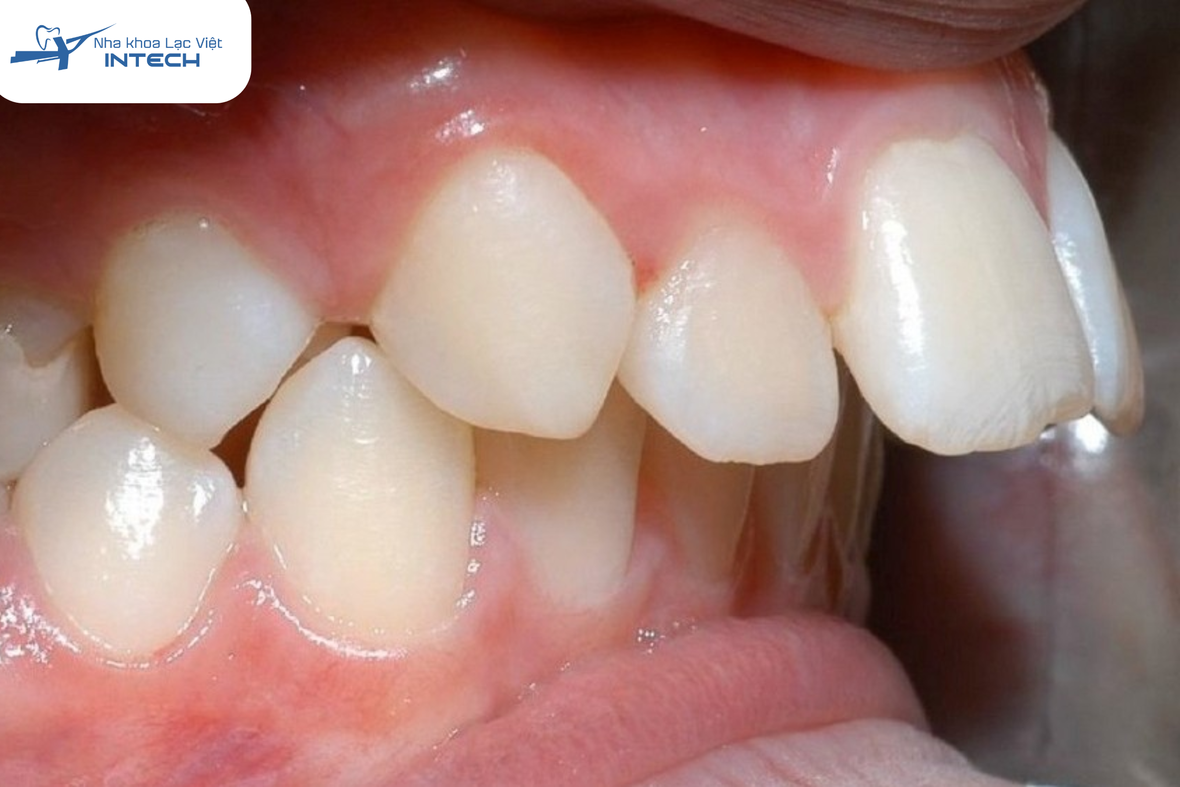 Răng hô ảnh hưởng rõ rệt đến chức năng ăn nhai và cấu trúc xương hàm không nên bọc sứ