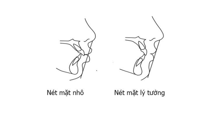 Đường thẩm mỹ e răng hô nhẹ có nên niềng không