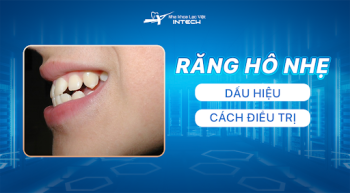 RĂNG HÔ NHẸ CÓ NÊN NIỀNG KHÔNG? 3 DÁU HIỆU CẦN BIẾT 