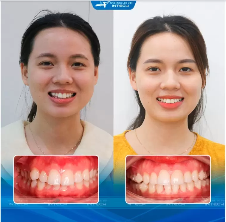 Răng hô niềng khay trong suốt 
