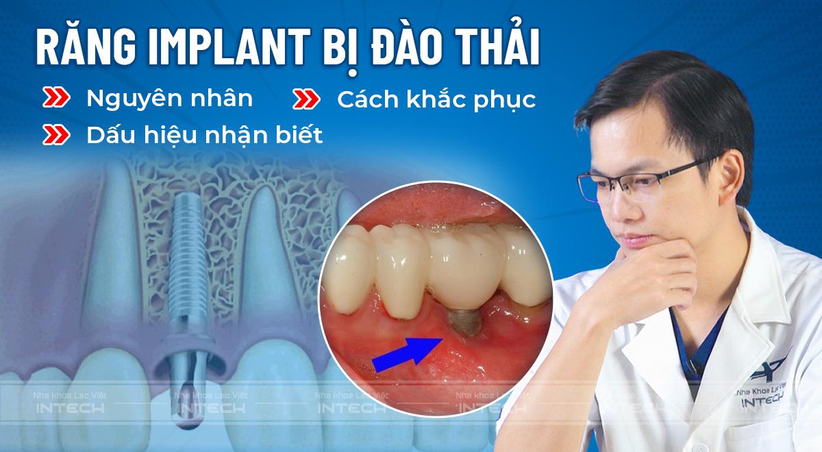 Nguyên nhân, dấu hiệu và cách khắc phục răng Implant bị đào thải