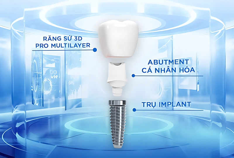 Răng Implant có cấu tạo gần như tương tự răng thật, tuổi thọ cao, sử dụng các chất liệu lành tính nên có giá thành cao hơn các phương pháp phục hình răng khác