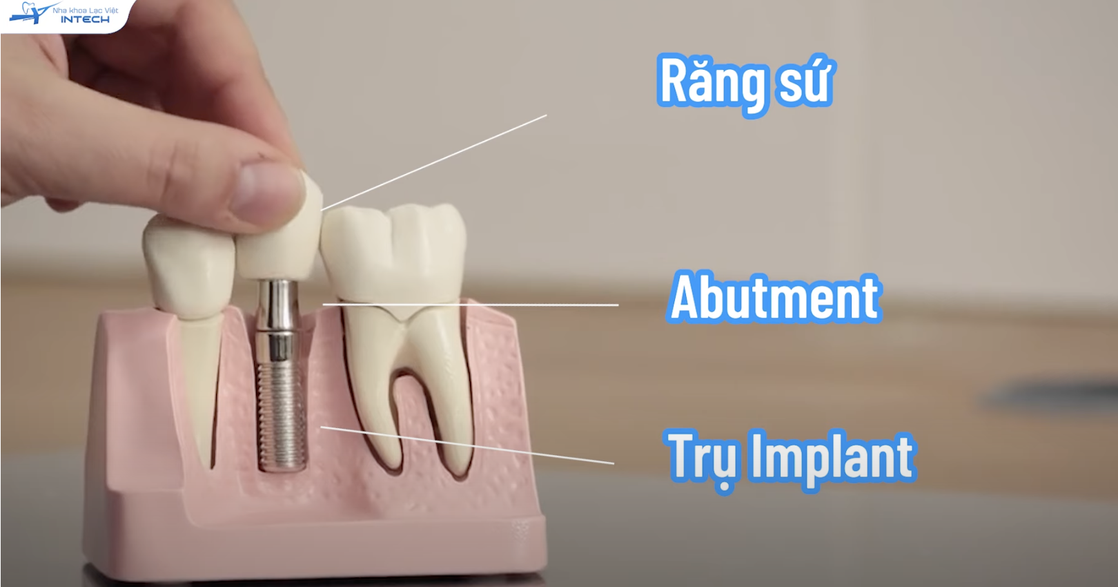 Răng Implant có khả năng tích hợp sinh học tốt, không làm ảnh hưởng đến các răng kế cận, ngăn ngừa tiêu xương hàm hiệu quả