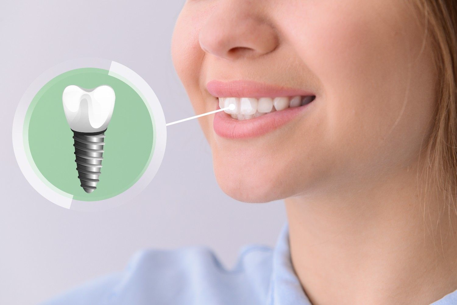 Răng Implant có thể tồn tại suốt đời nếu đáp ứng được thực hiện đúng kỹ thuật và chăm sóc răng đúng cách