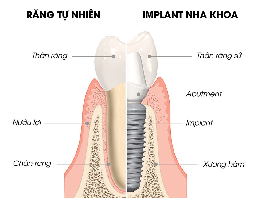 Việt kiều về nước làm rằng cần nhớ, hệ thống Implant hoàn chỉnh không chỉ có trụ mà còn có trụ phục hình và răng sứ