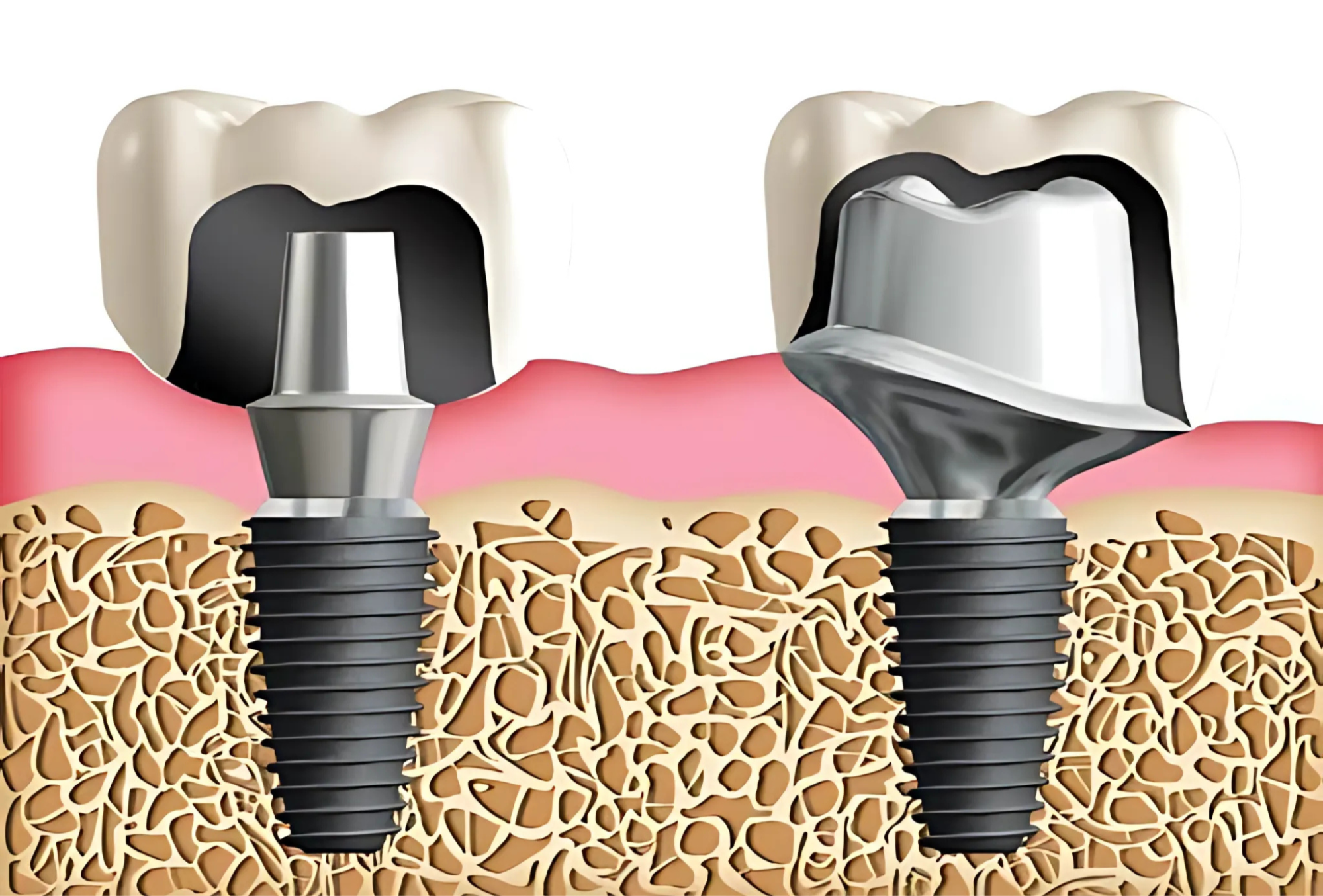 Răng Implant gồm 3 bộ phận mô phỏng cấu tạo của một răng thật, mỗi phần đảm nhận một nhiệm vụ riêng