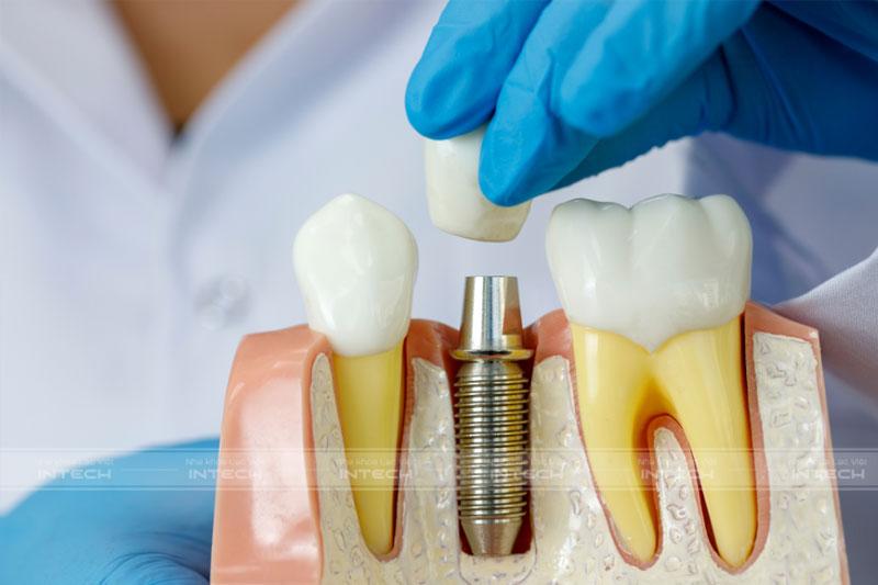 Trồng răng Implant phục hình răng mất độc lập tại vị trí mất răng, không gây khó chịu trong suốt quá trình sử dụng