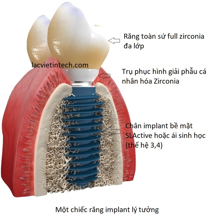 trụ phục hình trên răng implant