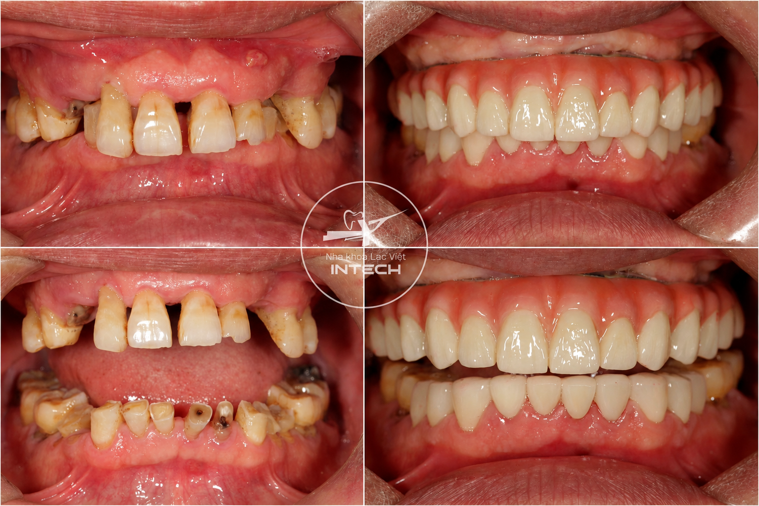 Hình ảnh trước và sau khi trồng răng Implant toàn hàm cho ca tiêu xương tại Nha khoa Lạc Việt Intech