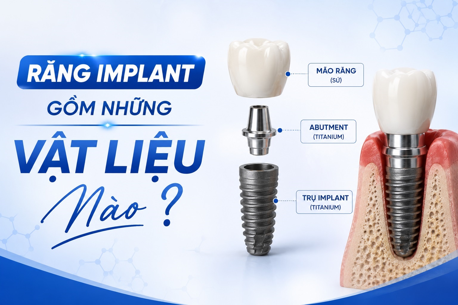 Răng Implant Gồm Những Vật Liệu Nào? Cấu Tạo Và Các Thành Phần Chi Tiết